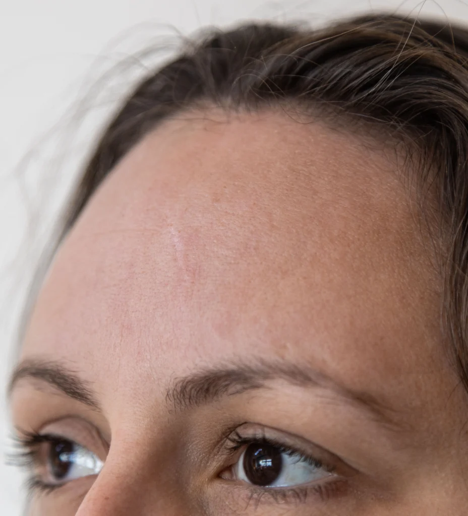 browlift large forehead