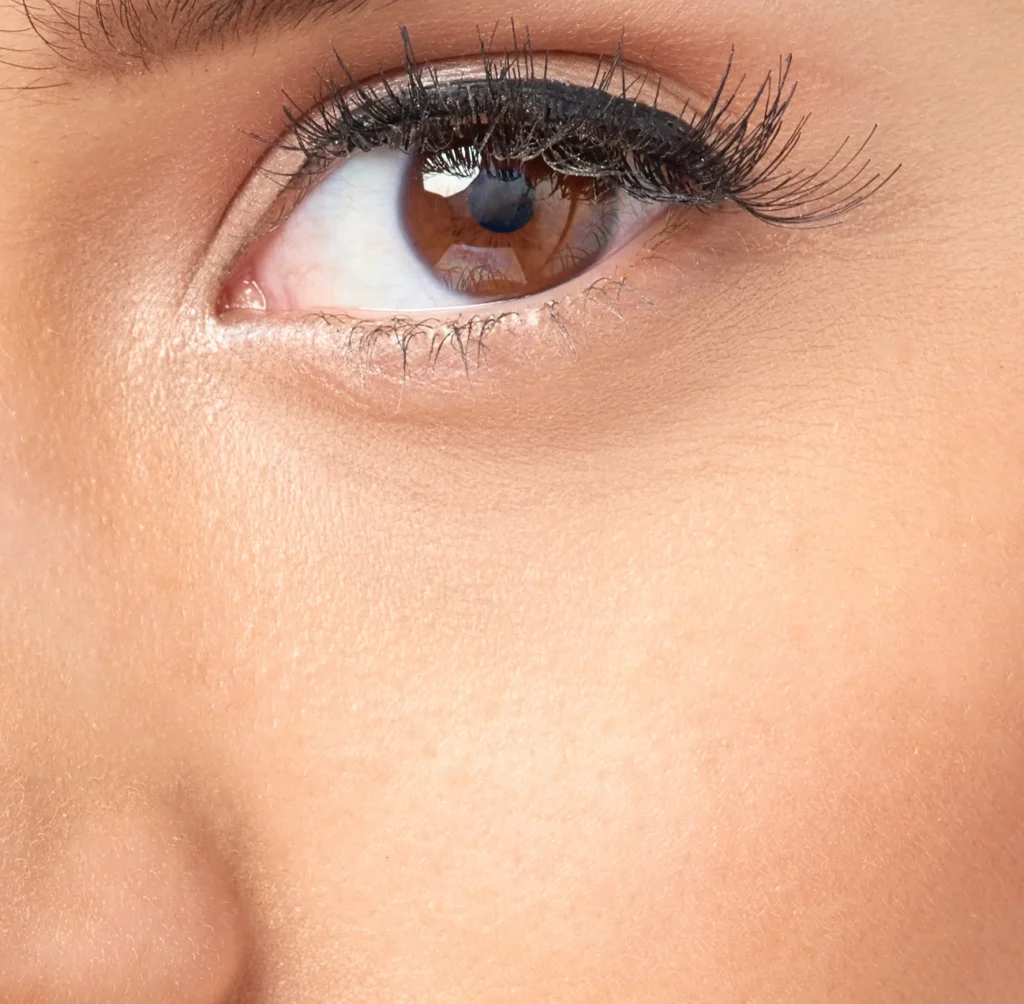 tear trough fat graft