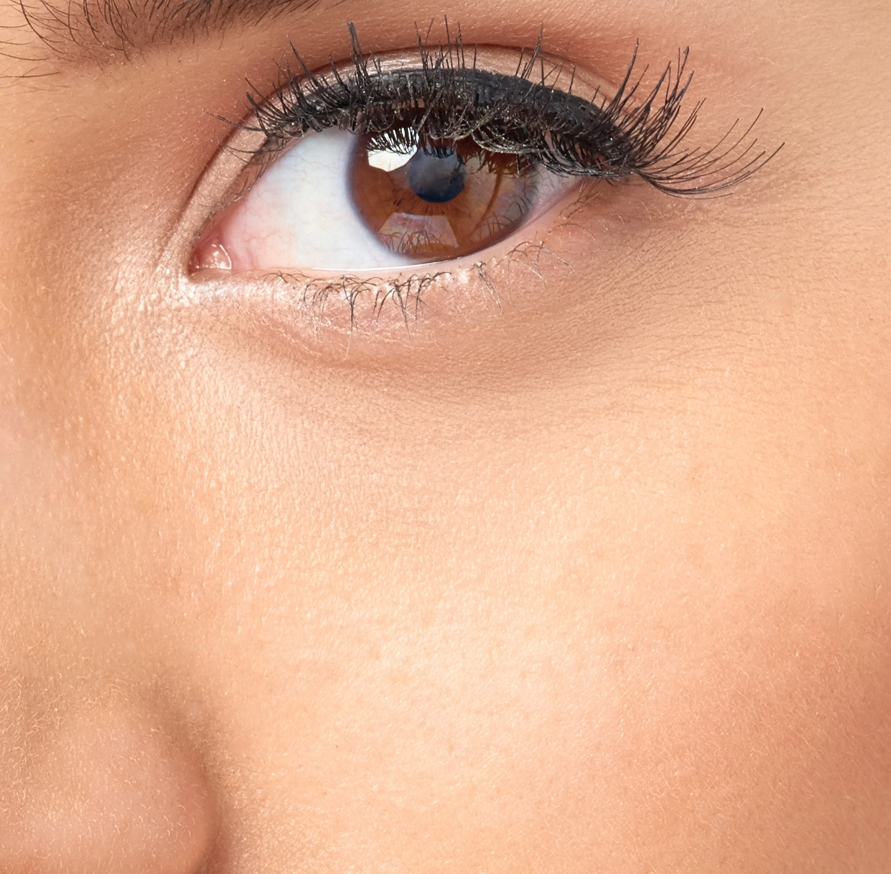 tear trough fat graft