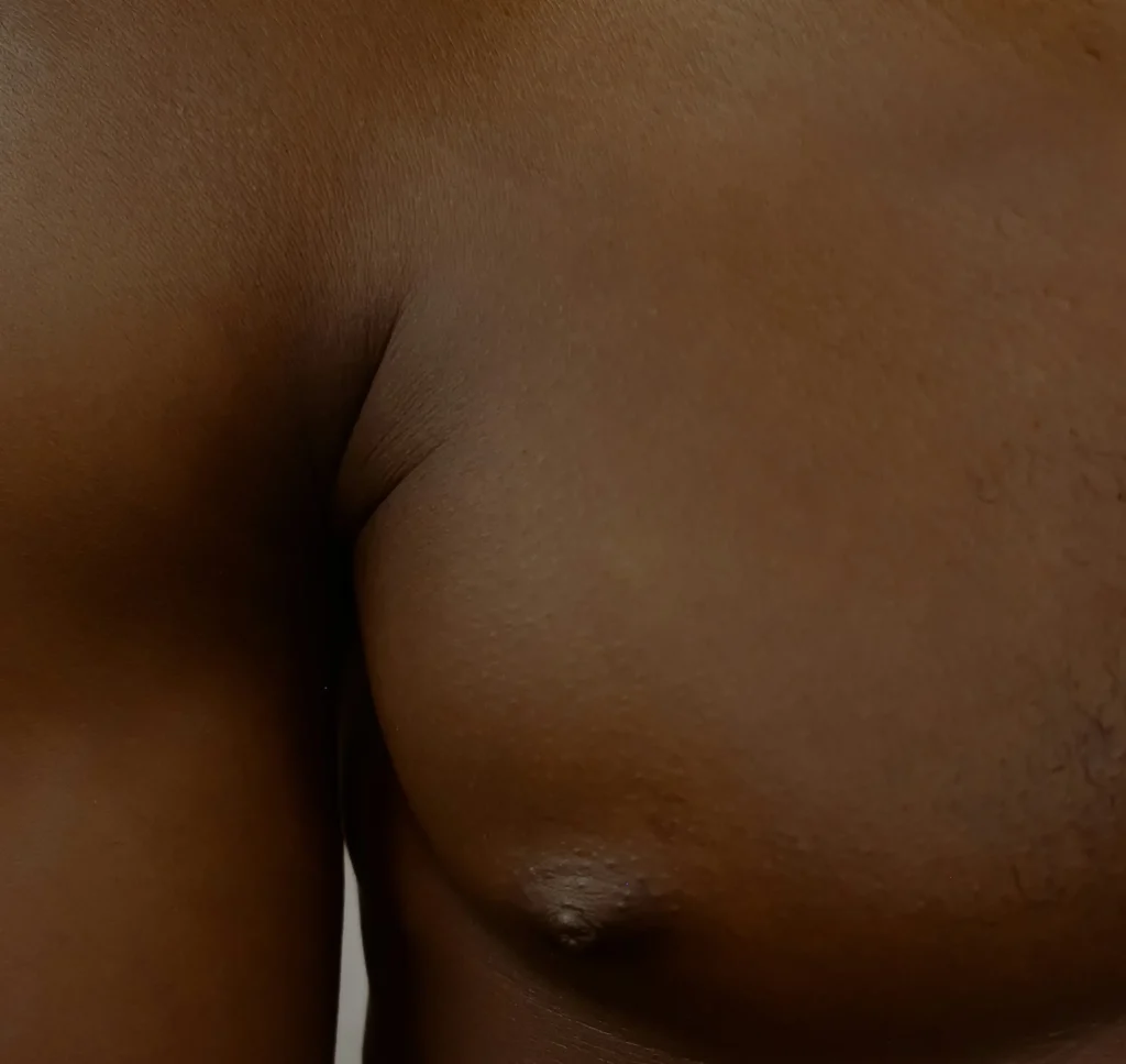 gynecomastia surgery patient