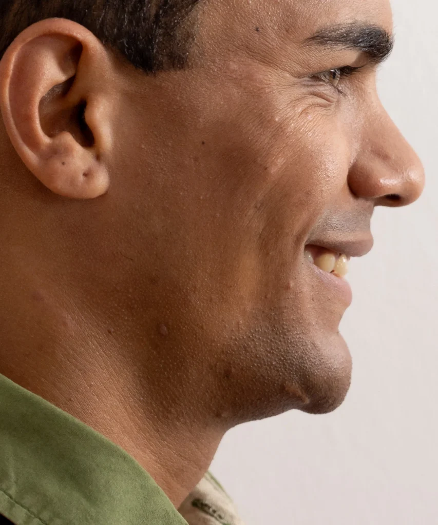 jaw augmentation preop