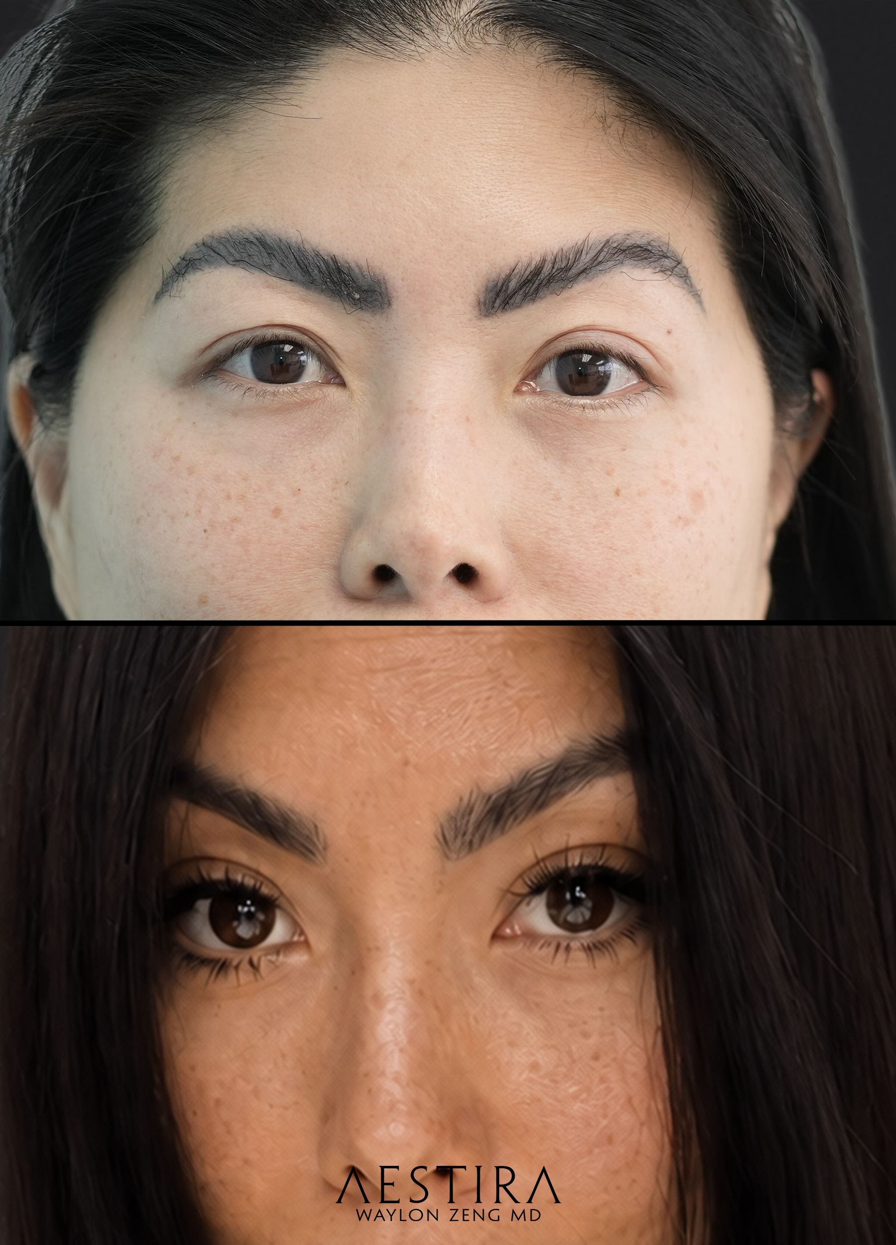 asian blepharoplasty